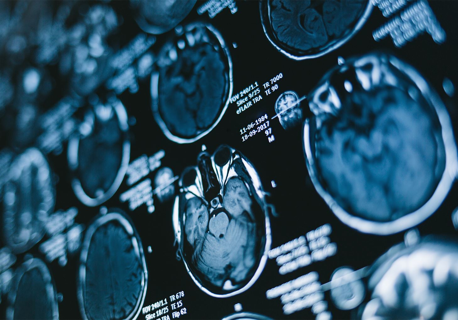 Catastrophic Injuries