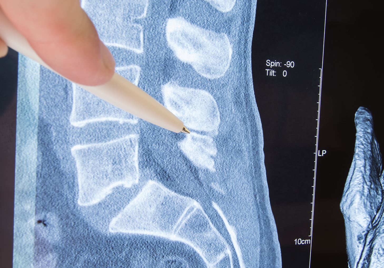 Spinal Cord Injuries